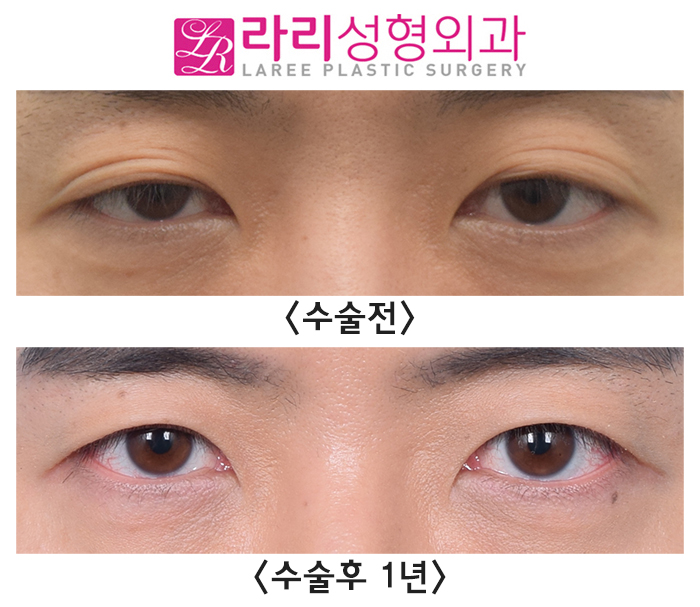 [Rari Plastic Surgery] Natural Double Eyelid Multiple Folds, Removing Them to Create a Monolid: Before and After Surgery After 1 Year image 1