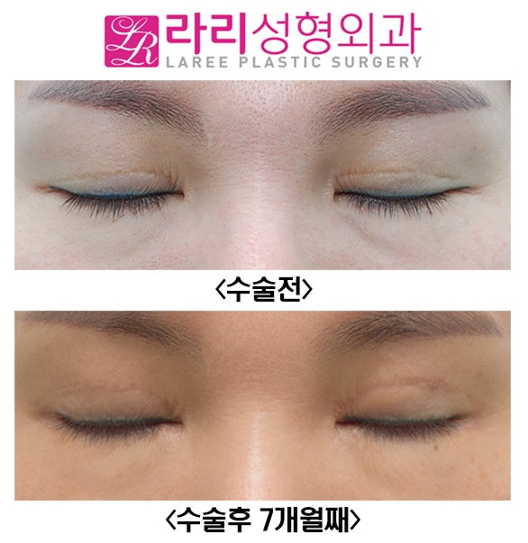 [라리성형외과] 쌍꺼풀재수술로 쌍수라인 높이기와 눈꼬리내리기뒤트임 관련 이미지 4