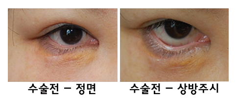 Complications of Lower Blepharoplasty: Ectropion Correction (Senile, Traumatic, Iatrogenic) image 2