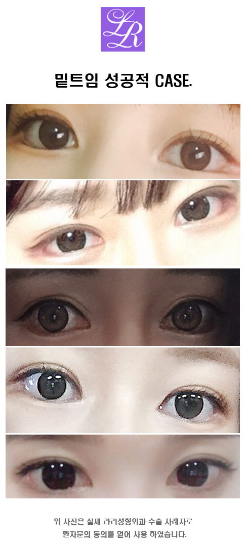 눈꼬리내리는수술, 눈 뒤트임 vs 눈 밑트임 관련 이미지 5