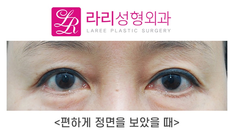 [Laree Plastic Surgery] My Eyelid Margin Is Turned Out—Could This Be Ectropion?!! (Self-Check by Symptoms) image 1