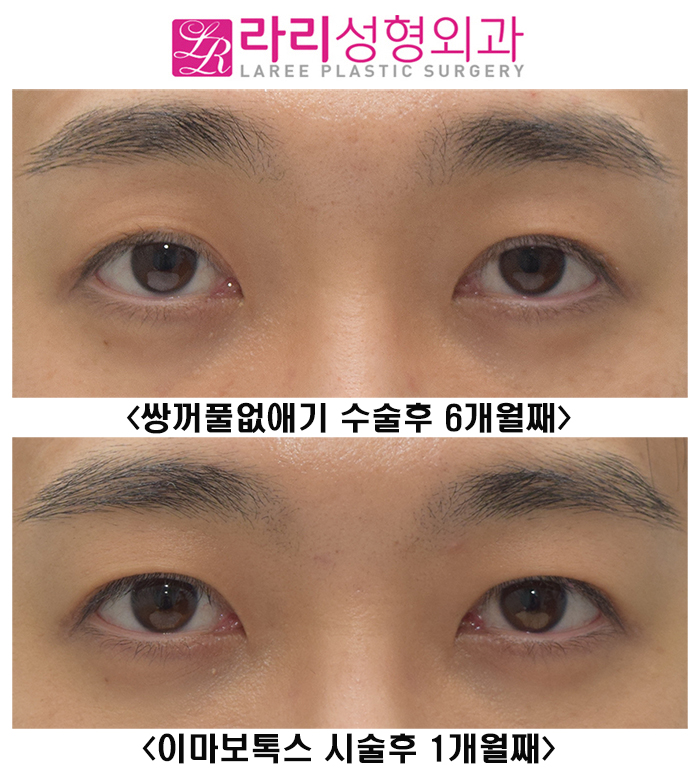 [Lari Plastic Surgery] Should You Get Forehead Botox Before Eye Surgery? image 4