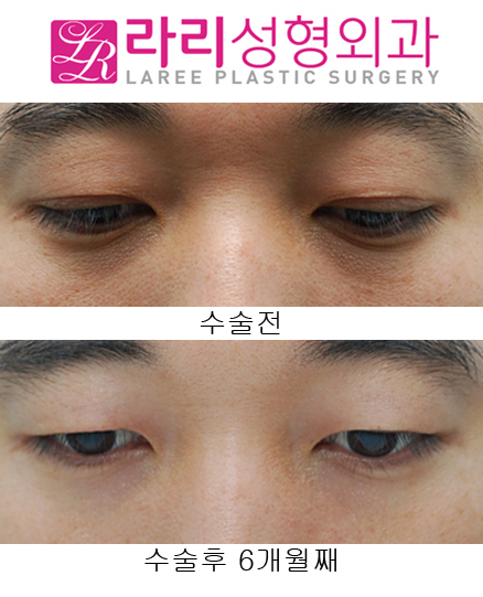 [Lari Plastic Surgery] Removing Double Eyelids After Multiple Buried Double-Eyelid Surgeries image 2