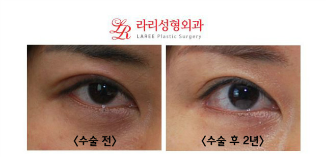 눈꼬리내리기뒤트임/뒷트임의 장기경과(1년이상) 사진☆ 관련 이미지 3