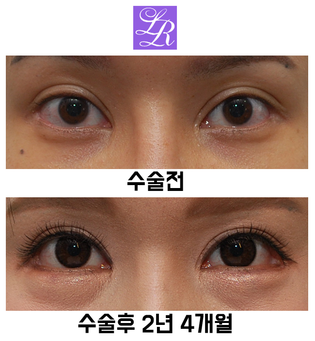 Postoperative Adhesion After Lateral Canthoplasty - The Effect of Revision Lateral Canthoplasty to Lower the Outer Eye Corner image 1