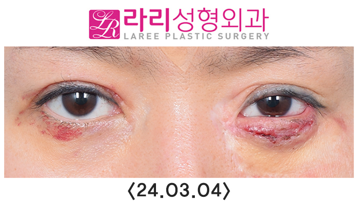 [라리성형외과] 연골이식으로 하안검외반의 일종인 삼백안 교정하기 관련 이미지 3