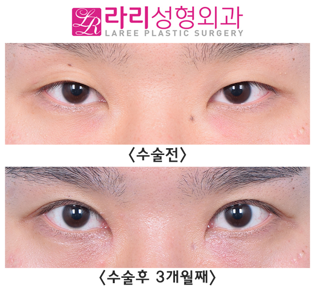 [라리성형외과] 이 정도 속쌍라인 절개눈매교정 어떤가요? 관련 이미지 1
