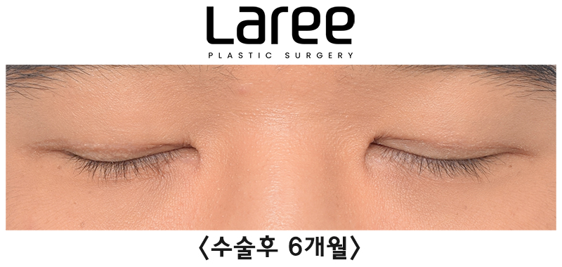 [Lari Plastic Surgery] Eyelid Correction Surgery and Upper Canthoplasty: Experiencing the Maximum Effect of Non-Double-Eyelid Eyelid Correction Without Medial Drooping image 9
