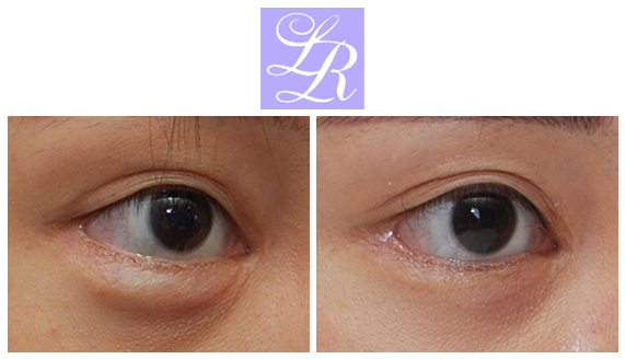 If You Want an S-Line Under Your Eyes, Try Lower Eye Widening image 8