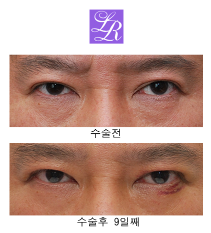 쌍꺼풀 푸는 수술/ 없애기 차이점은? 관련 이미지 4