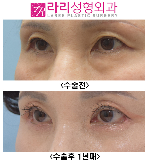 [Lari Plastic Surgery] Upper eyelid surgery, non-epicanthic inner corner surgery, revision outer corner surgery, and lower eyelid fat repositioning can all be done at once. Recovery with good results is possible! image 3