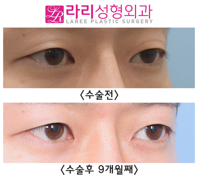 [라리성형외과] 무쌍으로 쌍꺼풀까지 없애는 절개눈매교정 관련 이미지 2