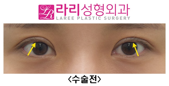 [Lari Plastic Surgery] Revision Double Eyelid Surgery to Correct Mucosal Exposure Caused by Sausage-Like Eyelids image 1