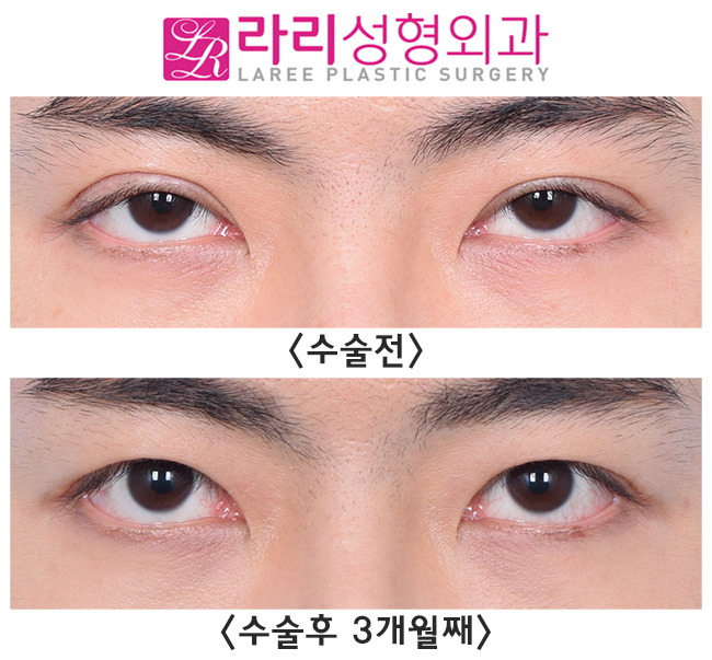 [라리성형외과] 일타쌍피, 한 번의 수술로 쌍꺼풀없애는수술과 눈매교정을 동시에 관련 이미지 1