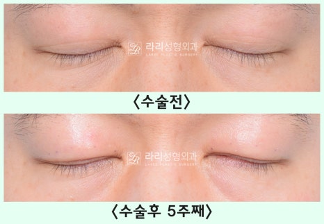 [Lari Plastic Surgery] Removing a Visible Double Eyelid (Double Eyelid Reversal Surgery), From Natural Double Eyelids to Surgical Double Eyelids: A to Z image 20