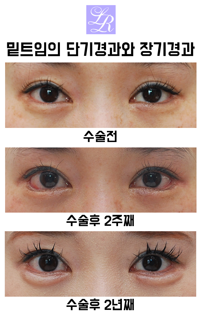 If You Want an S-Line Under Your Eyes, Try Lower Eye Widening image 13