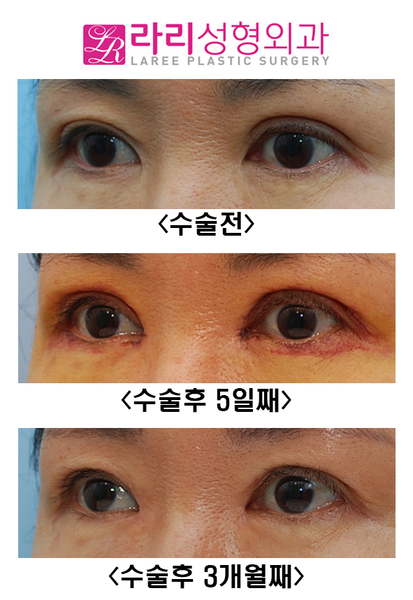 [라리성형외과] 두꺼운 소세지눈 교정 관련 이미지 5