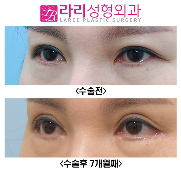 [라리성형외과] 쌍꺼풀재수술로 쌍수라인 높이기와 눈꼬리내리기뒤트임 관련 이미지 3