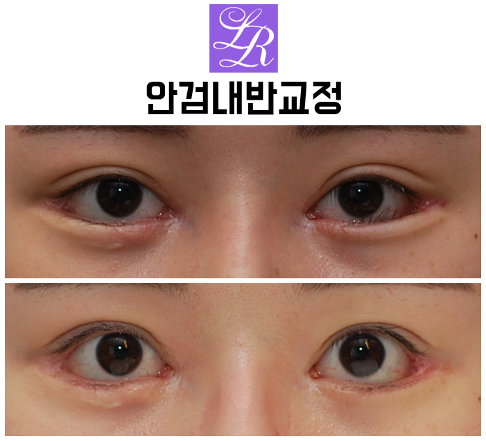 Can Lower-Eyelid Surgery and Entropion Correction Be Done at the Same Time? image 1