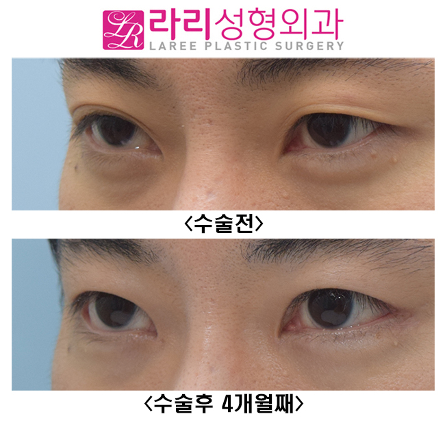 [라리성형외과] 쌍꺼풀없애는수술+ 트임없는앞트임수술+ 눈꼬리내리기뒤트임수술 = 또렷한 눈, 남자다운 눈, 멋있는 눈 관련 이미지 3
