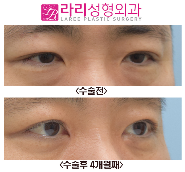 [Rari Plastic Surgery] Before-and-After Photos of Surgery to Remove the Double Eyelid Fold and Epicanthoplasty image 4