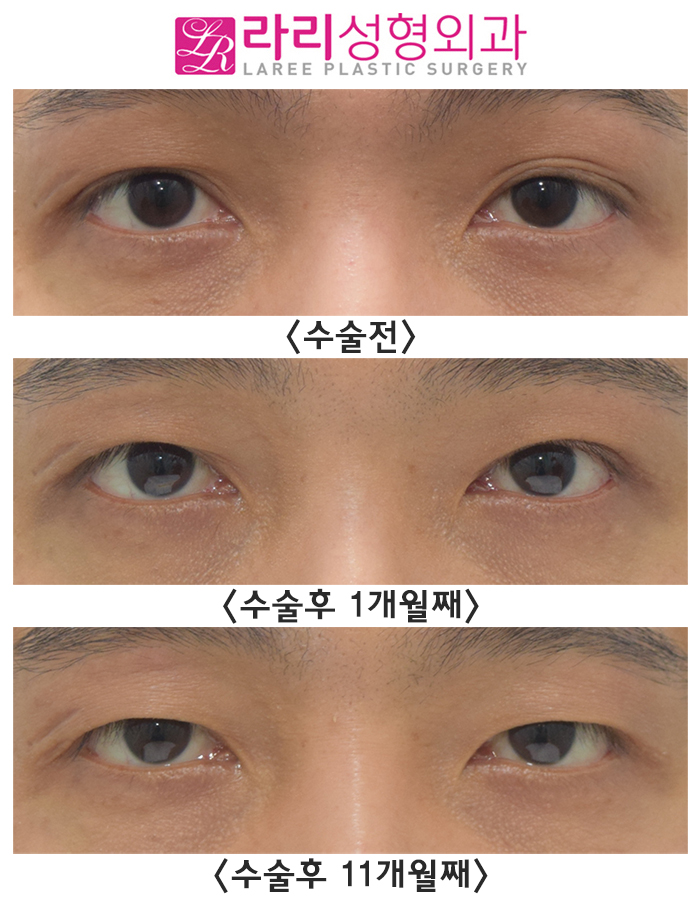 [Lari Plastic Surgery] Surgery to Remove Double Eyelids, Questions After Surgery. (Completely monolid? Upsetting because it is close to a monolid?) image 1