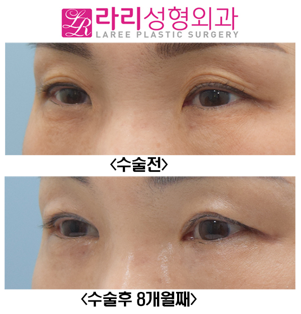 [라리성형외과] 여자도 하는 쌍꺼풀없애는수술, 앞트임수술과 찰떡 관련 이미지 2