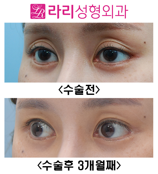 [라리성형외과] 쌍꺼풀재수술 눈두덩이 sunken 교정 관련 이미지 3