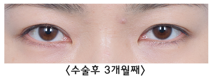 [라리성형외과] 쌍꺼풀재수술 라인낮추기 회복 기간 필수! 관련 이미지 4