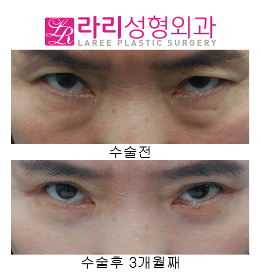 (Middle-aged) Upper Eyelid Surgery and Lower Eyelid Surgery at the Same Time image 5