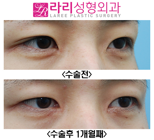 [Rari Plastic Surgery] Removing Double Eyelids Without a Crease and Medial Canthoplasty Are Effective for Changing the Look image 2