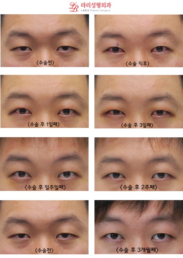 Single Eyelids Are the Trend for Men!!! XTM Men’s No-Double-Eyelid One-Day Eye Correction Before-and-After Progress Photos☆ image 2