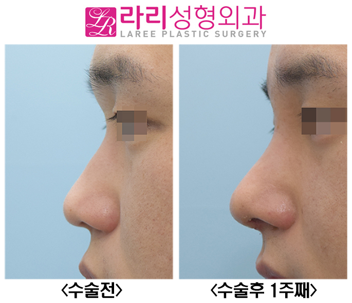 [Lari Plastic Surgery] Before-and-After Photos of Male Rhinoplasty with Rib Cartilage image 5