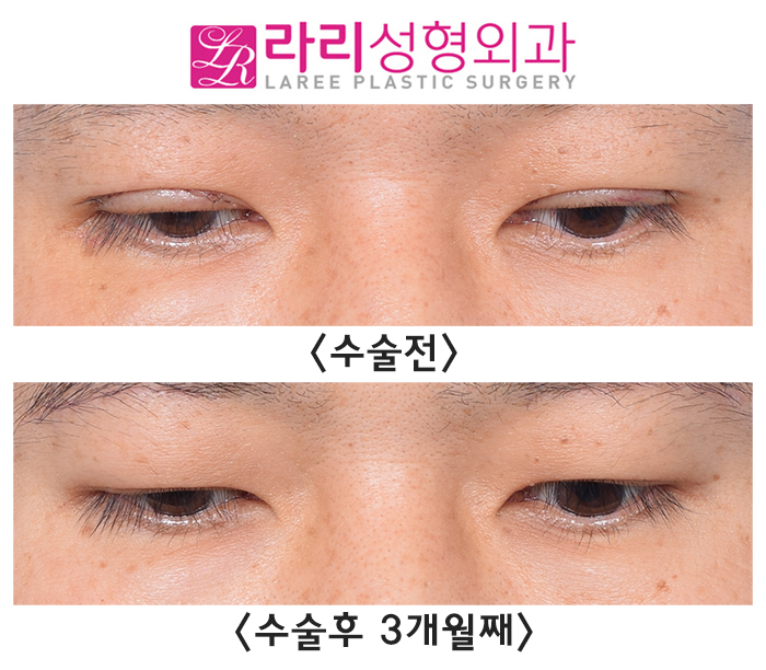 [라리성형외과] 절개 눈매교정 후 급속교정, 6개월 기다리지 않고 일주일 만에 쌍꺼풀없애기 관련 이미지 6