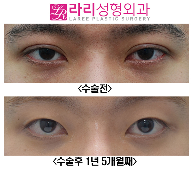 [Lari Plastic Surgery] Removing a Thick Natural Double Eyelid on Men image 1