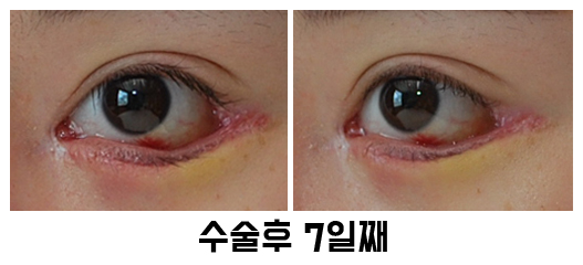 속눈썹 찌름 - 안검내반 교정 최소절개 흉터에 대해 관련 이미지 5