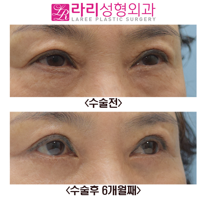 [라리성형외과] 상안검수술과 하안검수술 전후 사진 관련 이미지 3