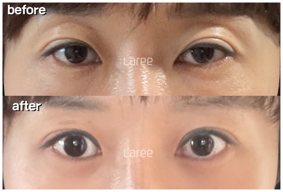 [Lari Plastic Surgery] The Real Way to Make Eyes Bigger: Eyelid Correction Surgery Is Needed Before Canthoplasty. image 3
