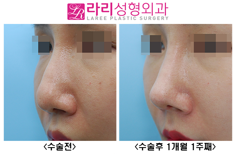 [Rari Plastic Surgery] Nose Bridge and Tip Surgery After Hyco Removal image 4