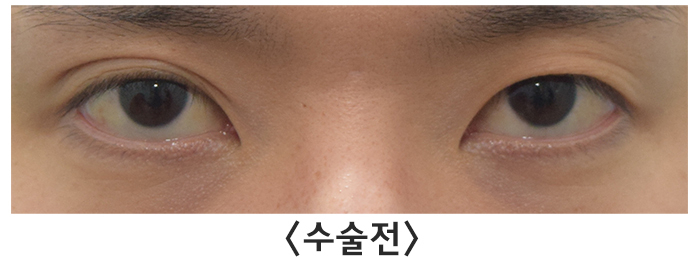 [라리성형외과] 여러 가지 쌍꺼풀 생기는 눈 무쌍으로 바꿔드립니다. 관련 이미지 4