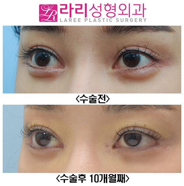 [Lari Plastic Surgery] Before-and-After Photos of Revision Canthoplasty for Downward Outer Eye Corners image 3