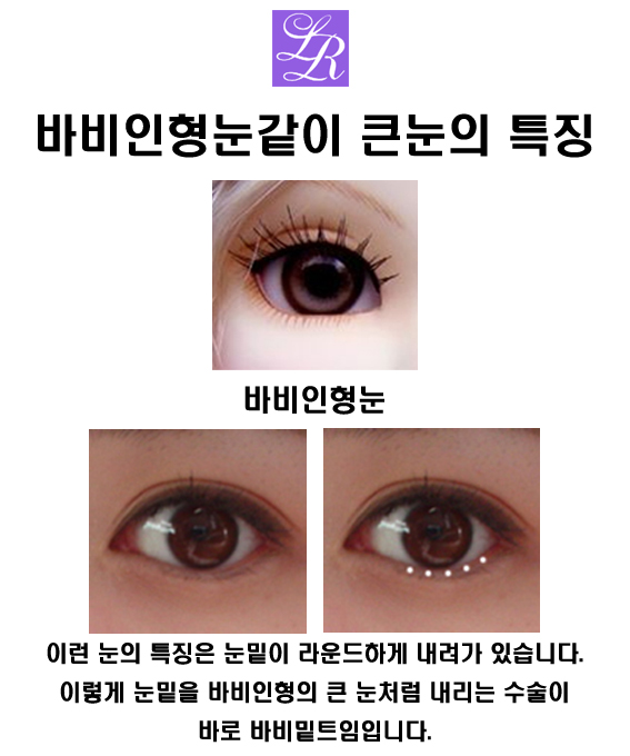 눈 밑트임 한것도 복원이 가능한가요? 관련 이미지 3