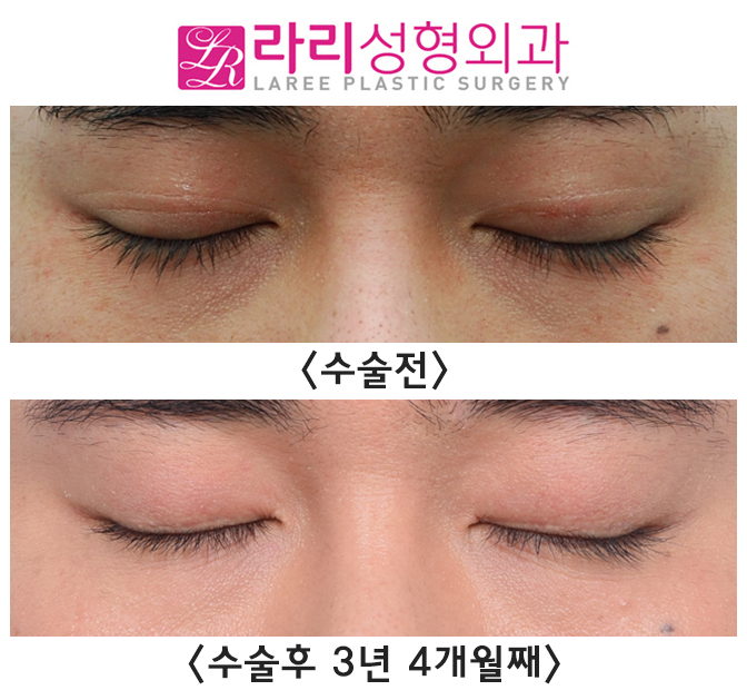 [라리성형외과] 매몰 쌍수, 쌍꺼풀 없애는 수술 장기 경과 전후 사진 그리고 실제  동영상 관련 이미지 3