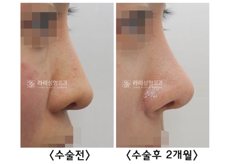 [라리성형외과] 절골을 포함한 매부리코 교정 수술(비순각 교정) 관련 이미지 8