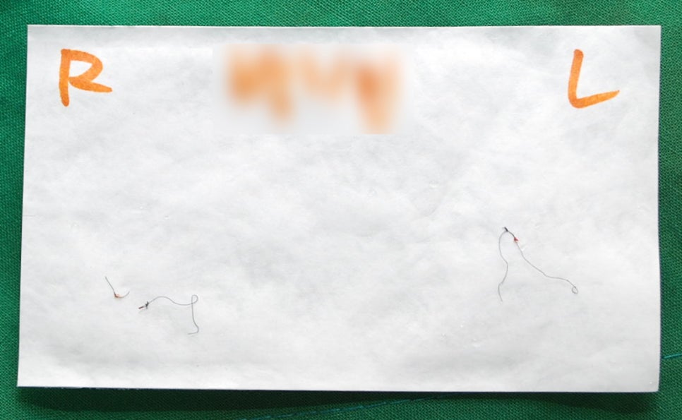 [라리성형외과] 매몰 쌍수가 풀리면 쌍꺼풀 재수술? NoNo 쌍꺼풀 없애기! 관련 이미지 2