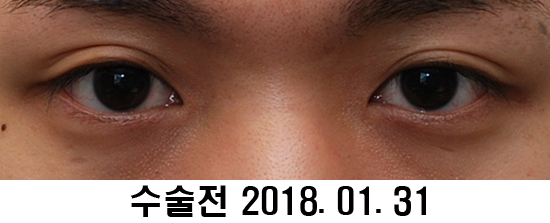 Before and After: Sharper Male Eye Correction (feat. Video) image 1