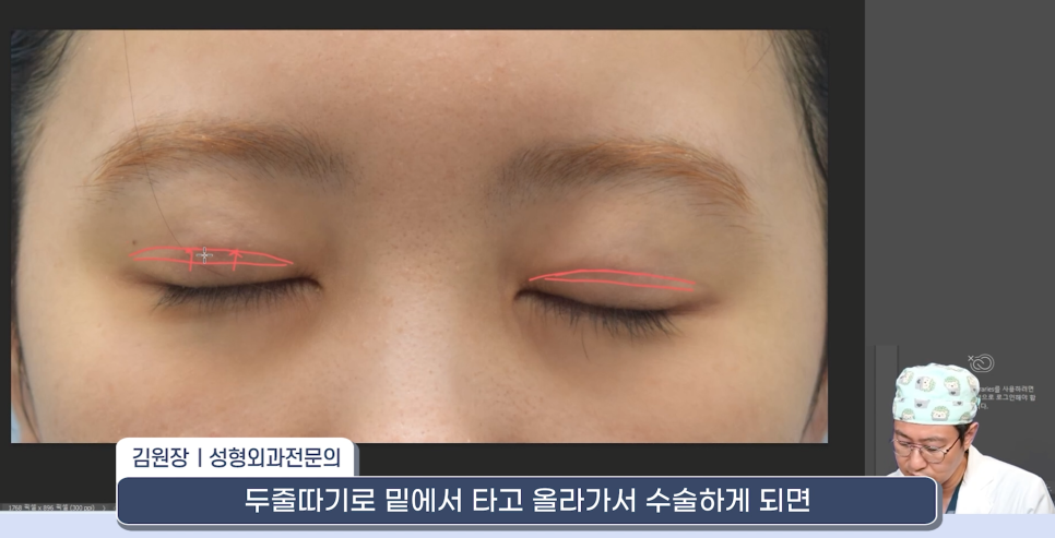 [라리성형외과] 쌍꺼풀재수술 라인 낮추는 두 가지 수술법 (절제방법 , 두줄따기방법) 관련 이미지 14