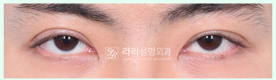 [Lari Plastic Surgery] Removing a Visible Double Eyelid (Double Eyelid Reversal Surgery), From Natural Double Eyelids to Surgical Double Eyelids: A to Z image 6