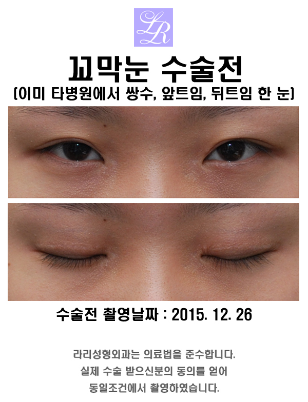꼬막눈 쌍수 - 짧은눈 왕눈이 수술 관련 이미지 1