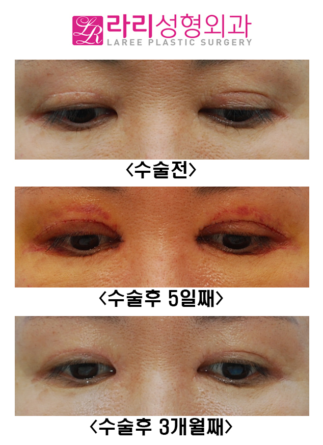 [라리성형외과] 두꺼운 소세지눈 교정 관련 이미지 2